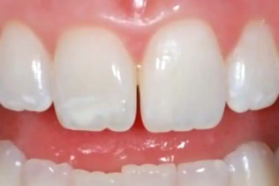 Side-by-side comparison of teeth before and after white spot treatment, showing reduced enamel mottling