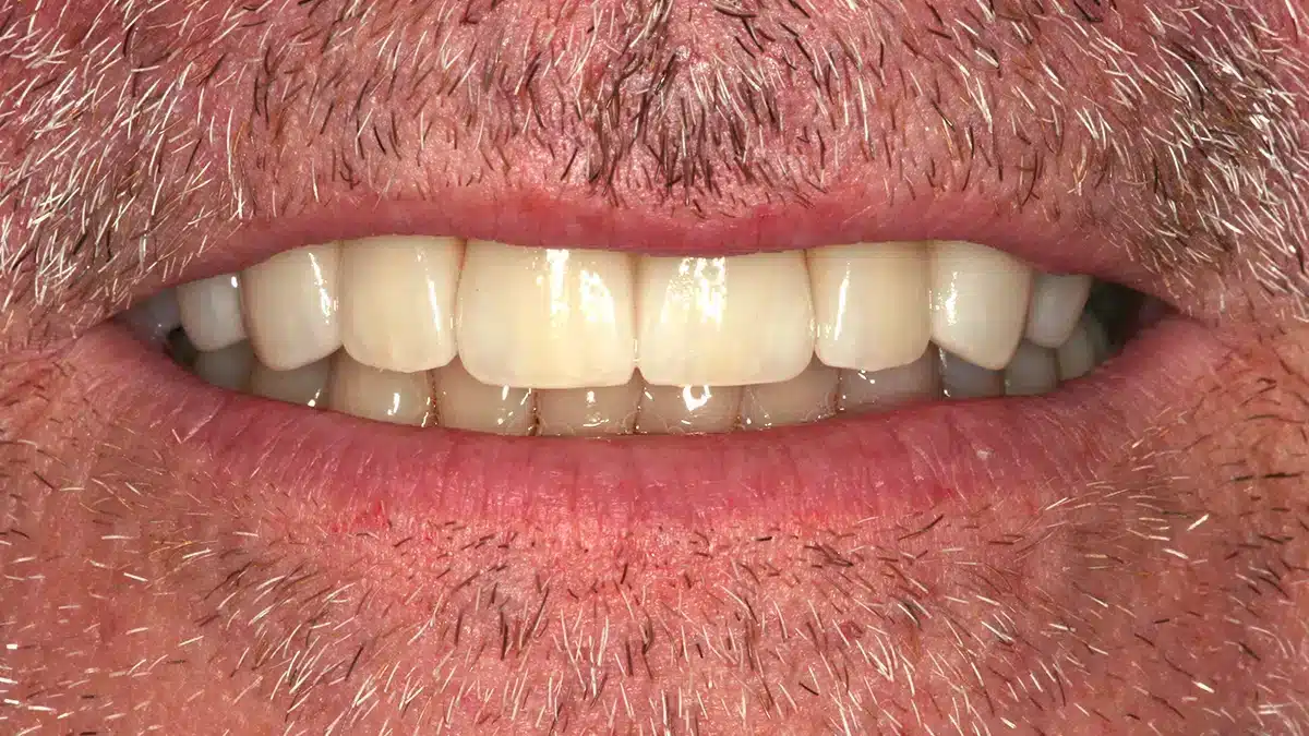 Close-up of lower teeth restored with a dental bridge to improve bite and appearance
