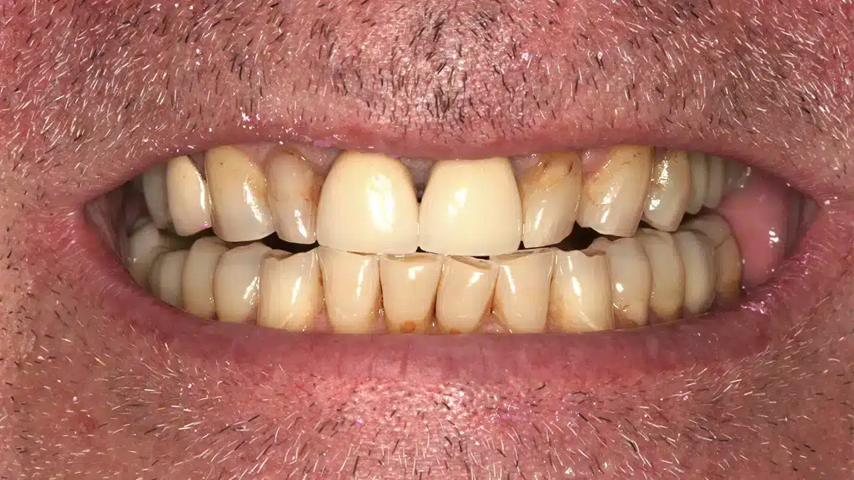 Close-up of lower teeth before being restored with a dental bridge to improve bite and appearance