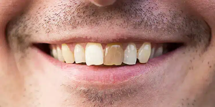 Damaged-front-tooth 1 Damaged front tooth