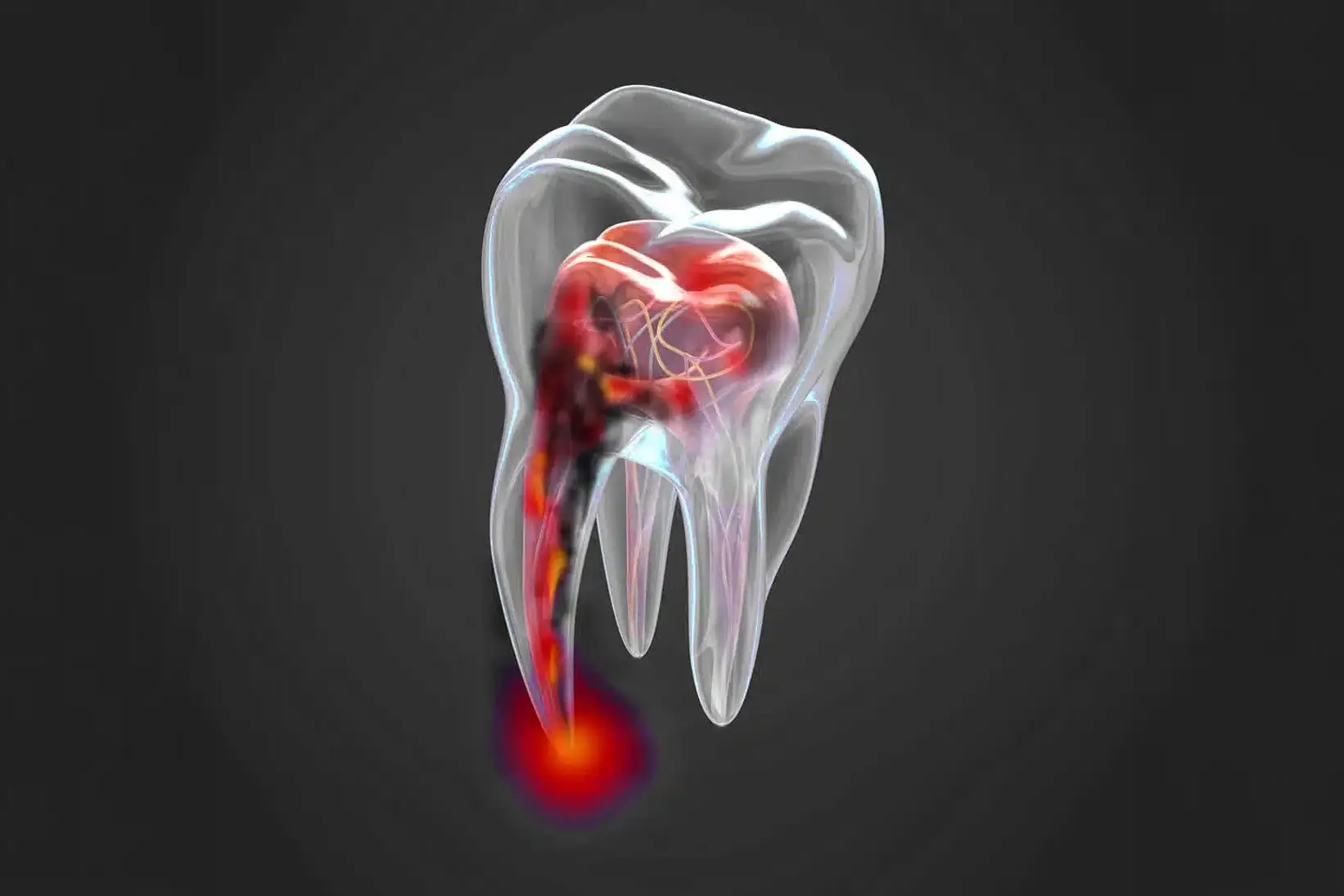 Damaged-root-in-tooth lighter 1 Damaged root in tooth lighter uai