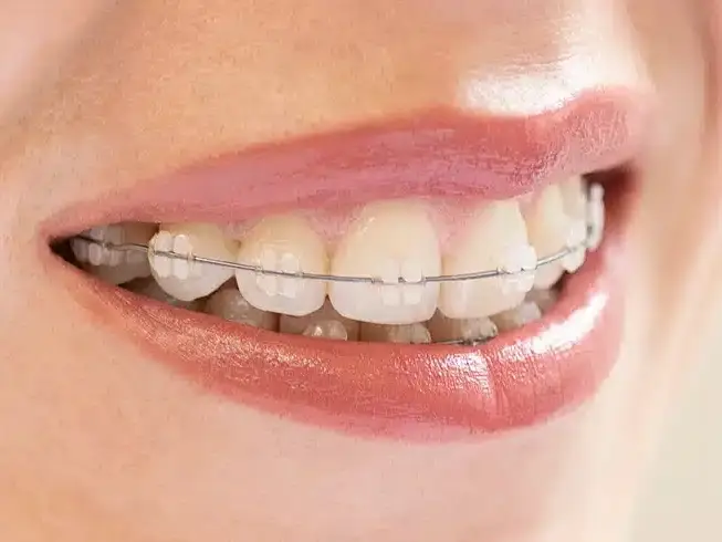 Close-up of smiling woman wearing aligners for orthodontic treatment