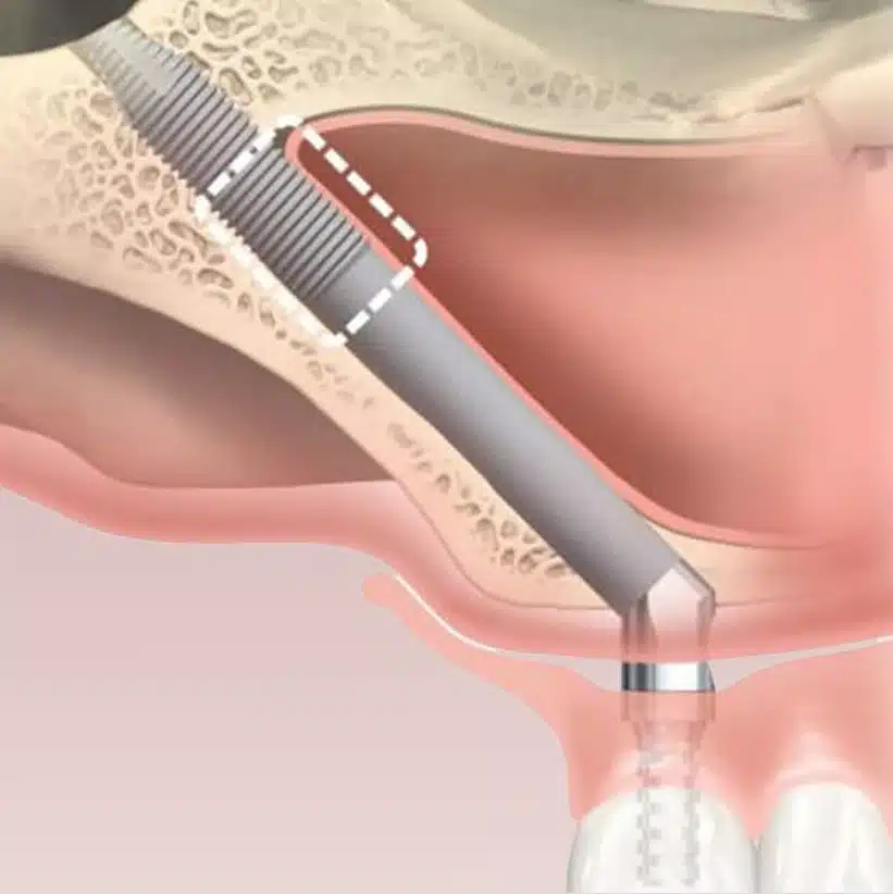 Placement-of-Zygo-Implant 1 Diagram showing angled placement of a zygomatic implant into the upper jaw and cheekbone