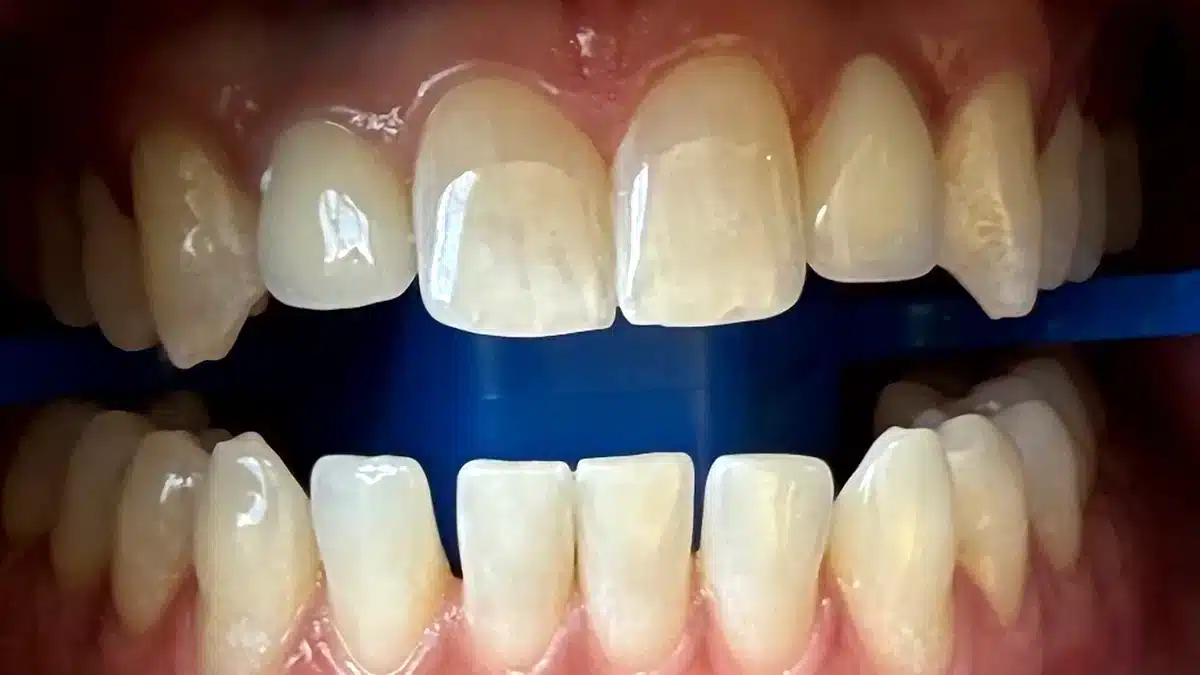 Before-and-after image of upper teeth with improved colour and brightness after treatment by Tannaz Joorabchian