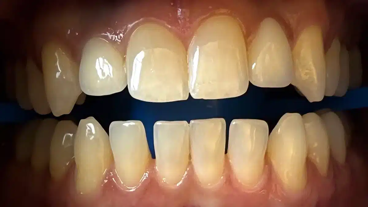 Before-and-after image of upper teeth with improved colour and brightness after treatment by Tannaz Joorabchian