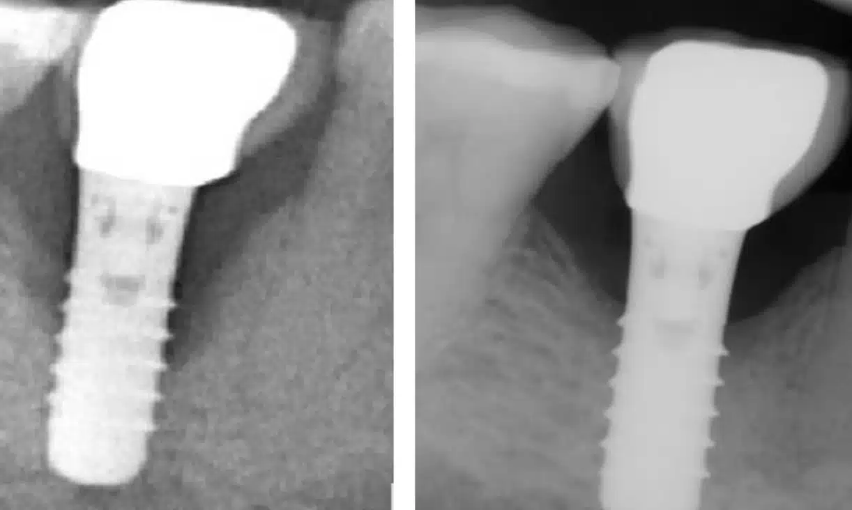 Treatment of Periodontitis