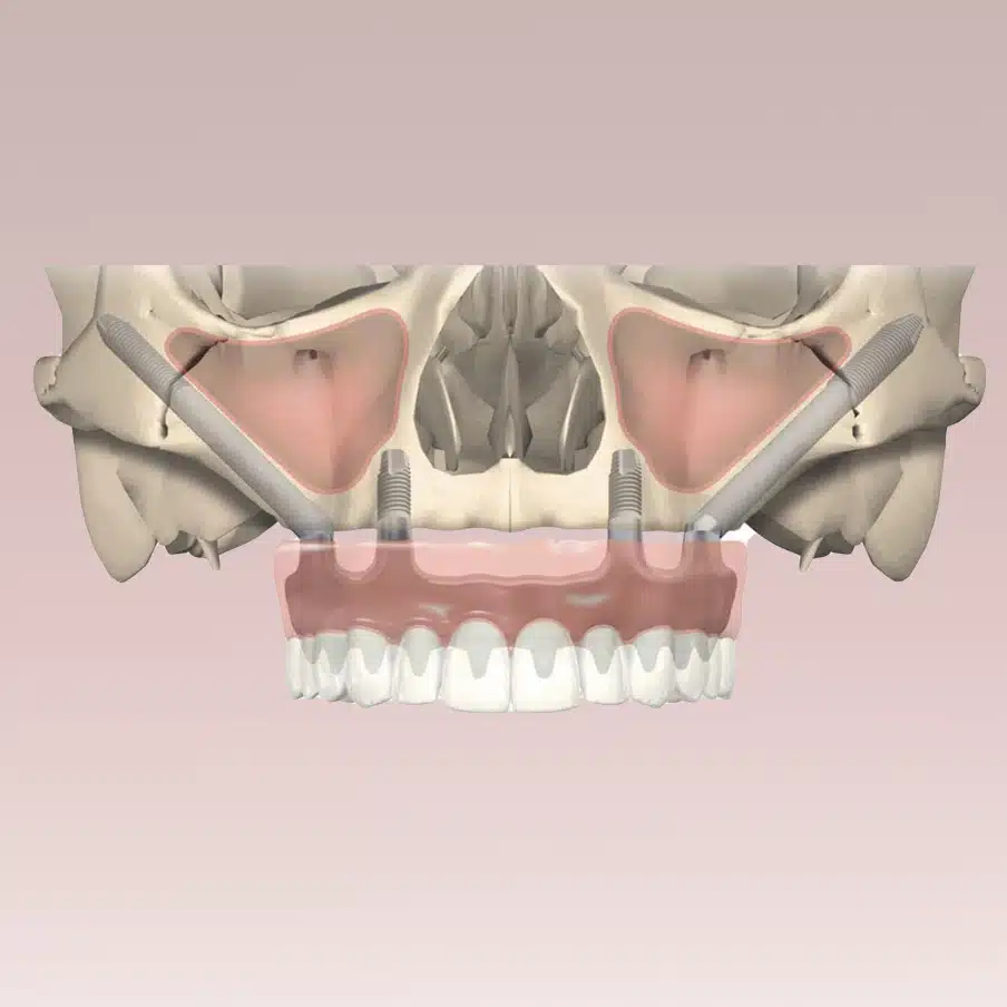 Zygomatics-advanced 2 3D visual showing two zygomatic implants and two conventional implants supporting a fixed upper prosthesis
