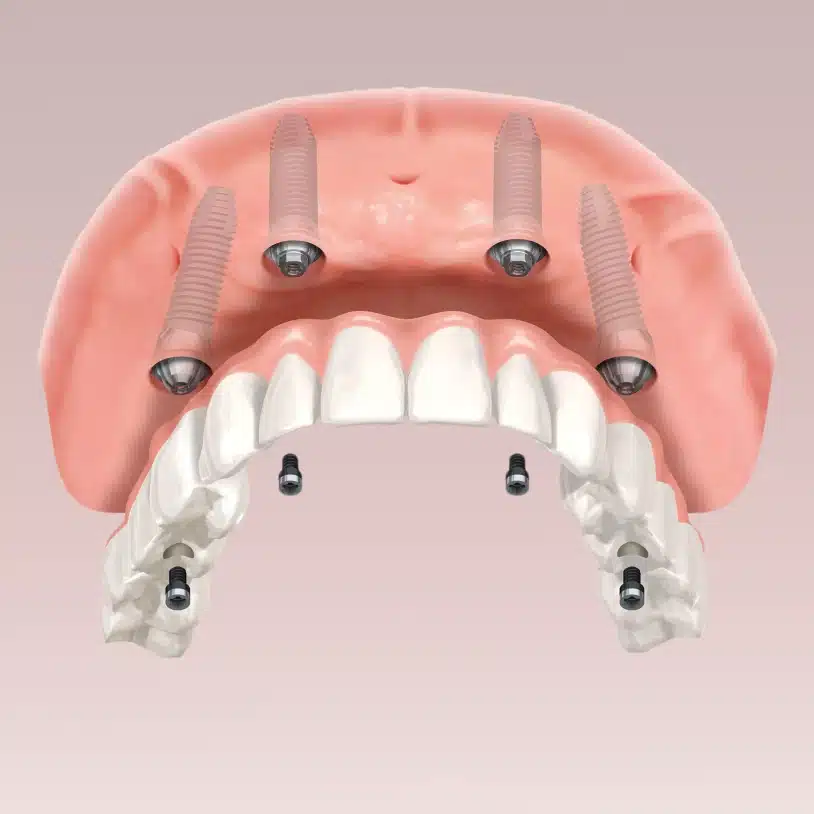 Diagram showing four strategically placed dental implants supporting a fixed full arch bridge