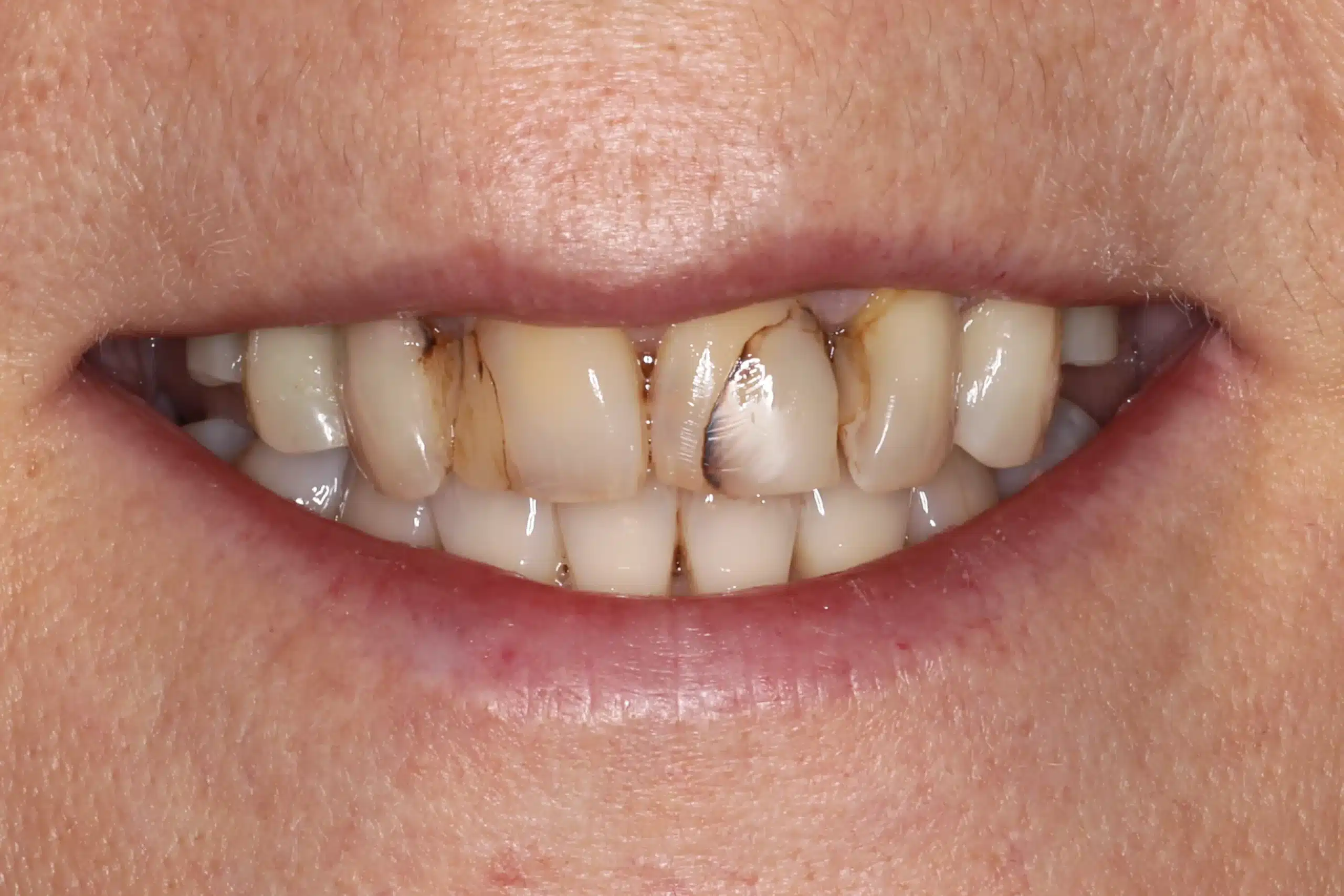Before photo of upper front teeth showing damaged and stained teeth