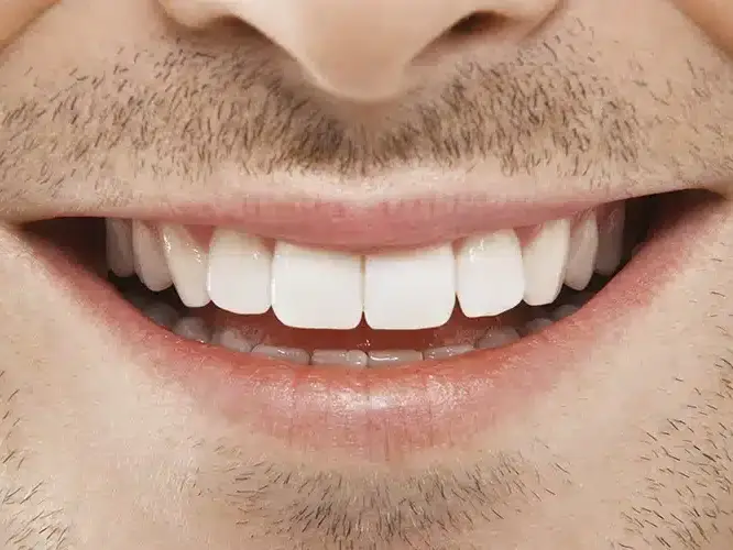 Close-up of restored teeth showing well-fitted dental crowns