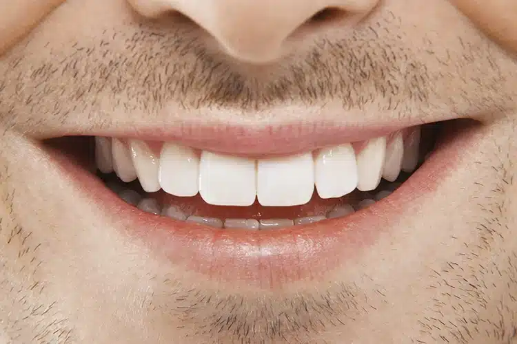 Close-up of restored teeth showing well-fitted dental crowns
