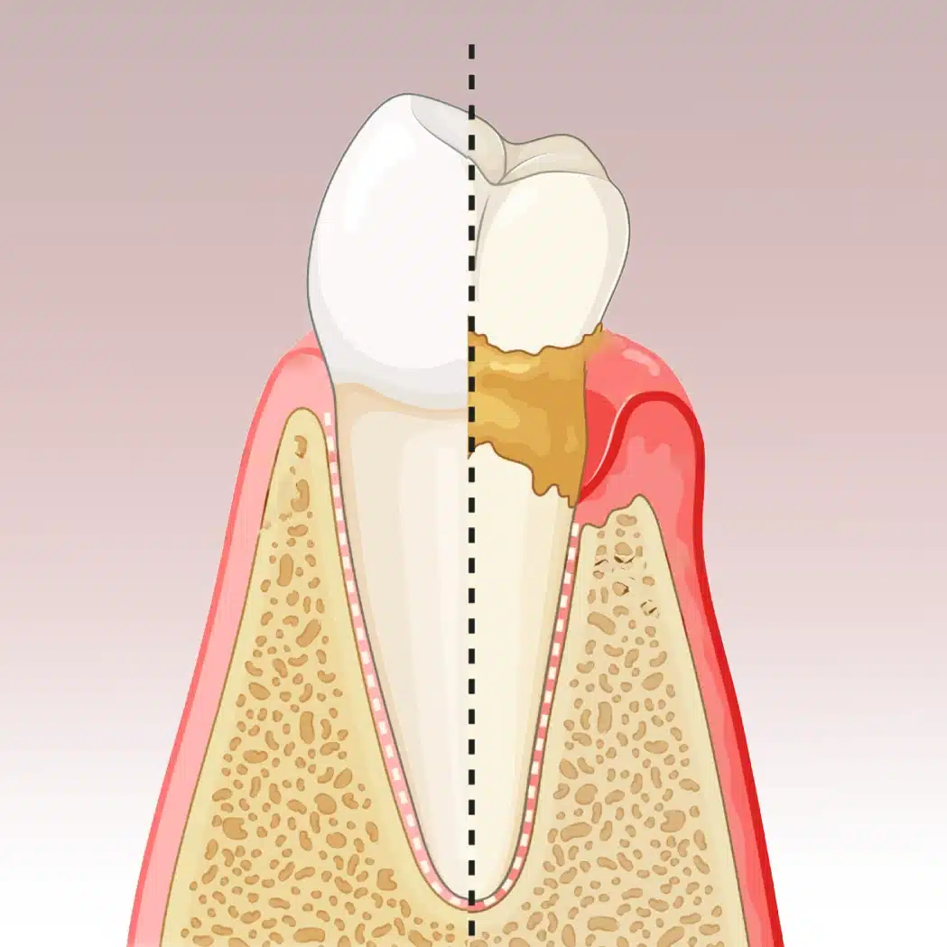gum disease 1