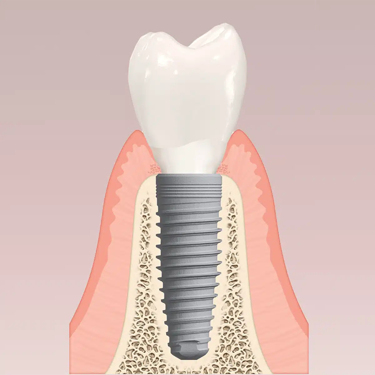 single-implant 1 single implant