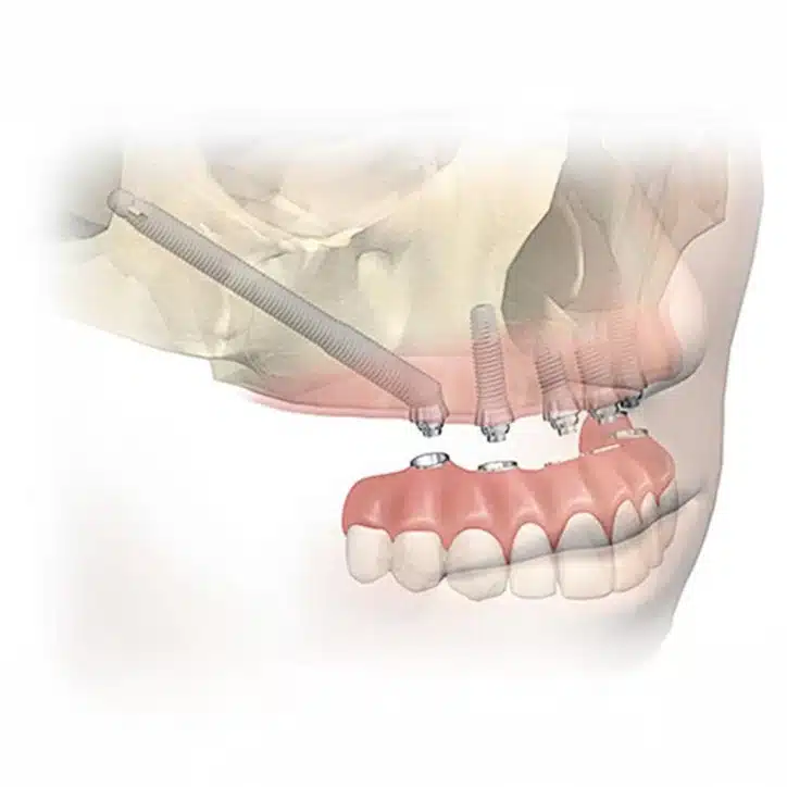 Zygomatic Implants 9 Zygomatic Implants