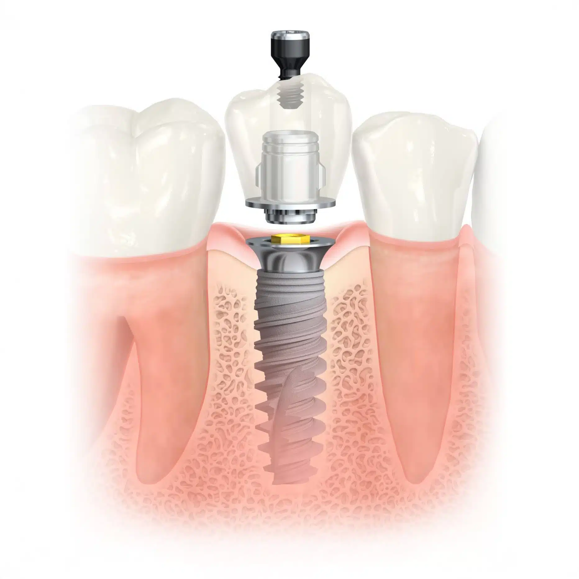 single implant 7 Dental Implants at Dawood & Tanner