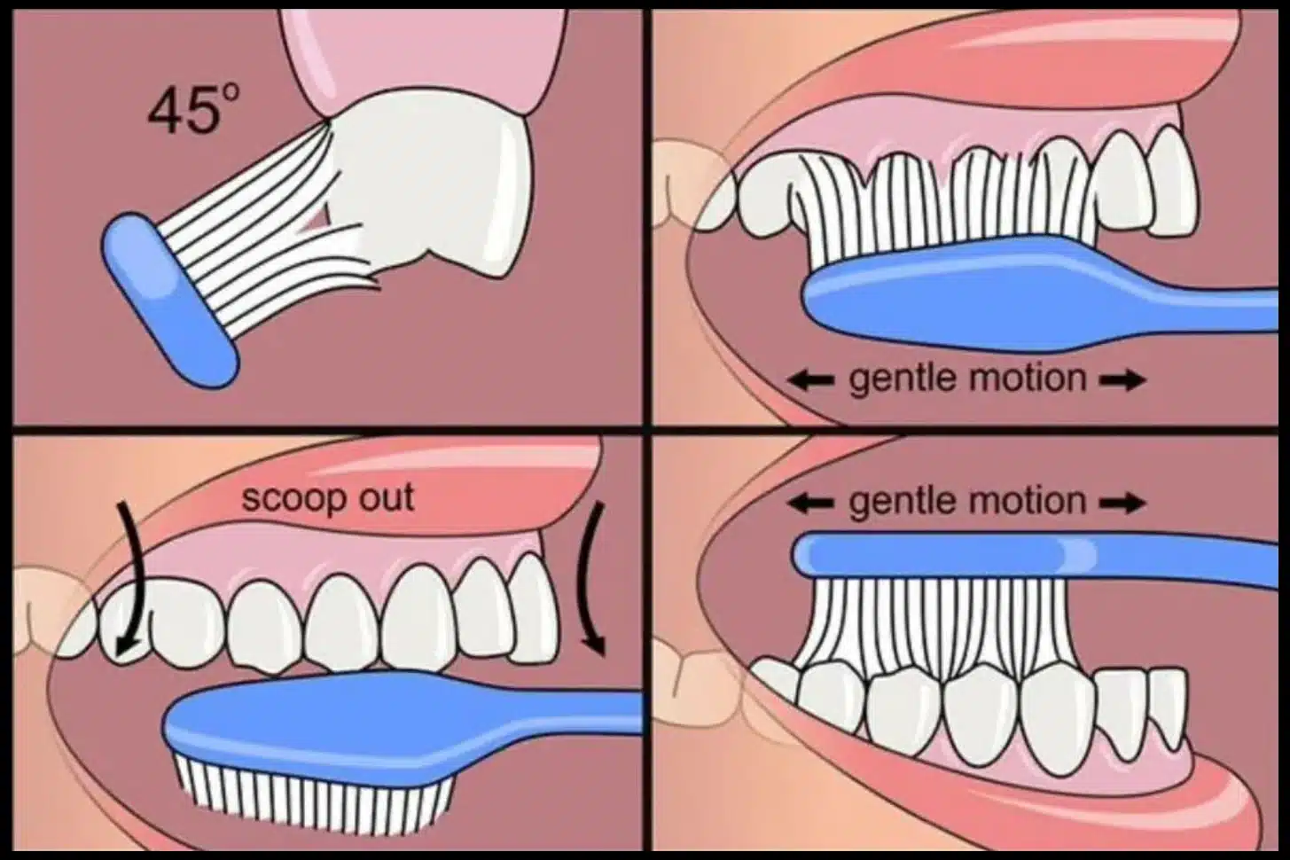Toothbrushing technique diagrams Two educational diagrams showing correct brushing angle and technique, including gum line brushing and circular motions