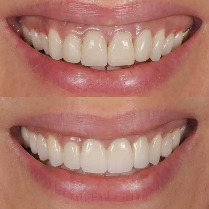 A chandrapal Smile Makeover