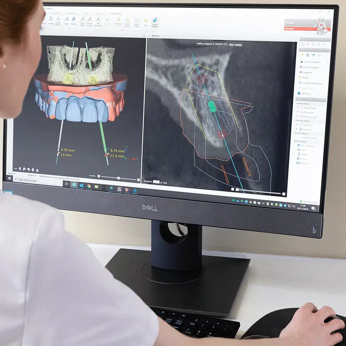 Dental Implant Planning Digital Dentistry