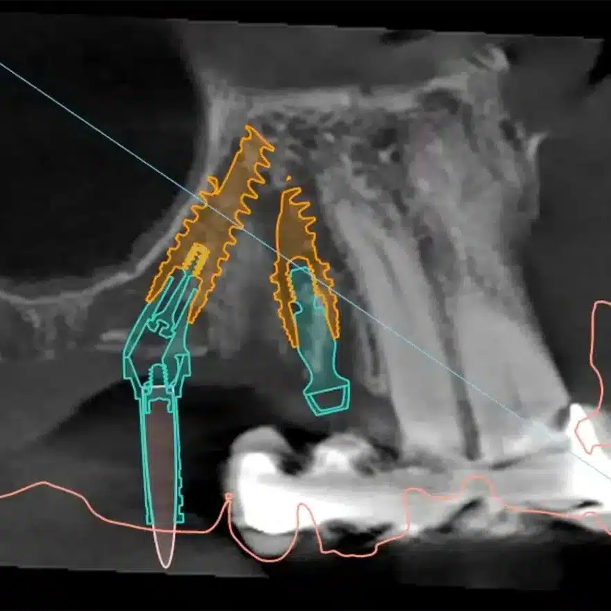 Digital Implant Planning 3 Digital Planning