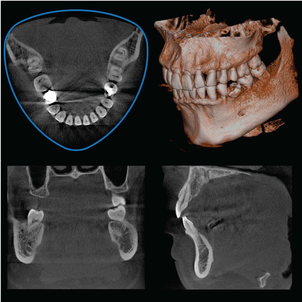 3D Imaging: Morita CBCT 2 r100 full arch